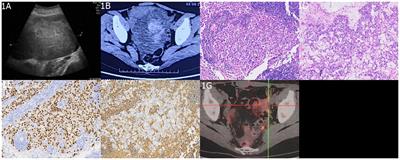 Adult ovarian and sellar region mixed germ cell tumor: a case report and literature review
